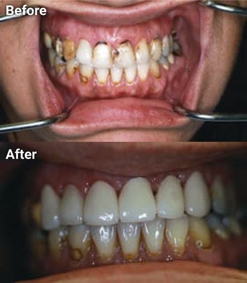 The image shows a before-and-after comparison of dental treatments, with the top half showing a mouth with discolored teeth and gums, and the bottom half displaying the same mouth after treatment, revealing a cleaner appearance.