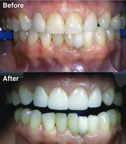 The image shows a before-and-after comparison of a dental treatment process, with the before side showing yellowed teeth and the after side displaying a clean, white smile following a cleaning procedure.