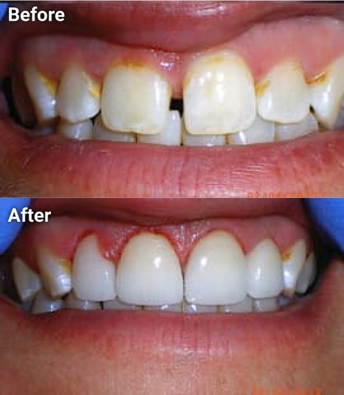 The image shows two photographs side by side of a person s teeth before and after dental treatment, with a focus on the dramatic transformation achieved through cleaning and whitening.