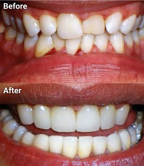 The image shows a side-by-side comparison of a person s teeth before and after cosmetic dental treatment, highlighting the improvement achieved through tooth whitening or bleaching.