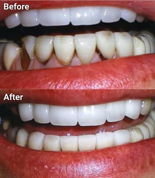 The image shows a before-and-after comparison of dental treatment, with the left side showing teeth with discoloration and the right side displaying clean, white teeth after professional cleaning.