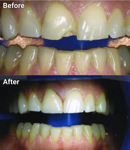 The image shows a side-by-side comparison of a teeth whitening process, with the top half showing a yellowed set of teeth before treatment and the bottom half displaying the same teeth after being whitened, demonstrating the results of dental teeth bleaching.