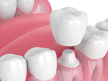 The image displays a close-up graphic of a collection of artificial teeth with varying shades of pink and white, set against a red background.