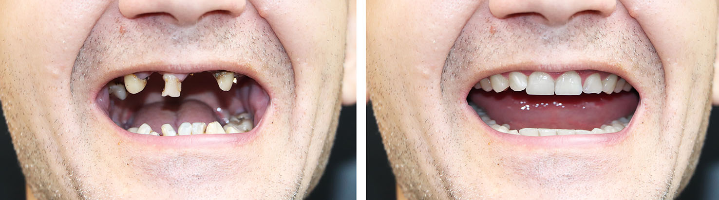 The image shows a collage of four photos featuring a man with an open mouth displaying his teeth, with each photo capturing a different facial expression and angle.
